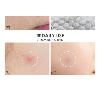 Acne Pimple Patch